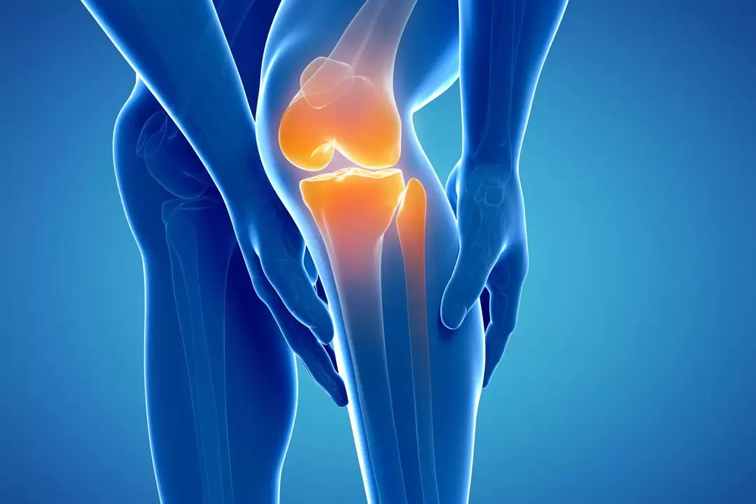 Arthrosis sendi lutut (gonarthrosis, deforming osteoarthritis)