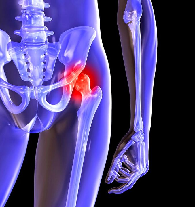Meringkaskan arthrosis sendi pinggul
