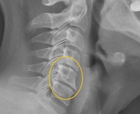 Osteochondrosis tulang belakang serviks pada x -ray