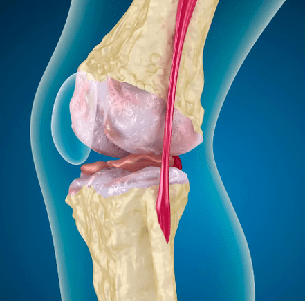 Arthrososis sendi lutut