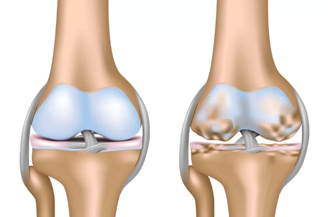 Meringkaskan arthrosis sendi lutut