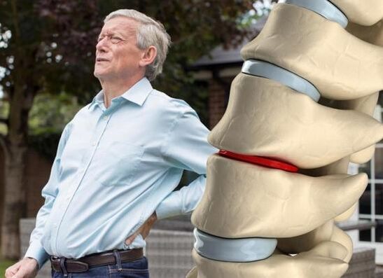 Osteochondrosis menjejaskan cakera intervertebral dan menyebabkan sakit belakang
