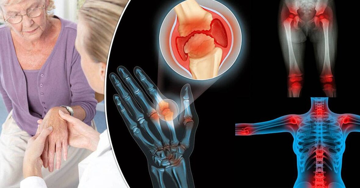 apa itu arthrosis